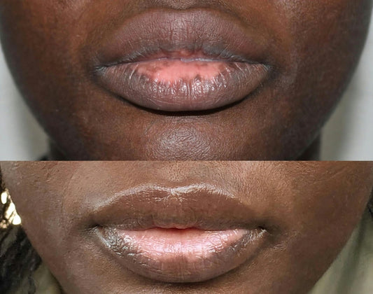Before and after vitiligo lips